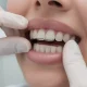 Liseré noir entre gencive et dent : causes et solutions